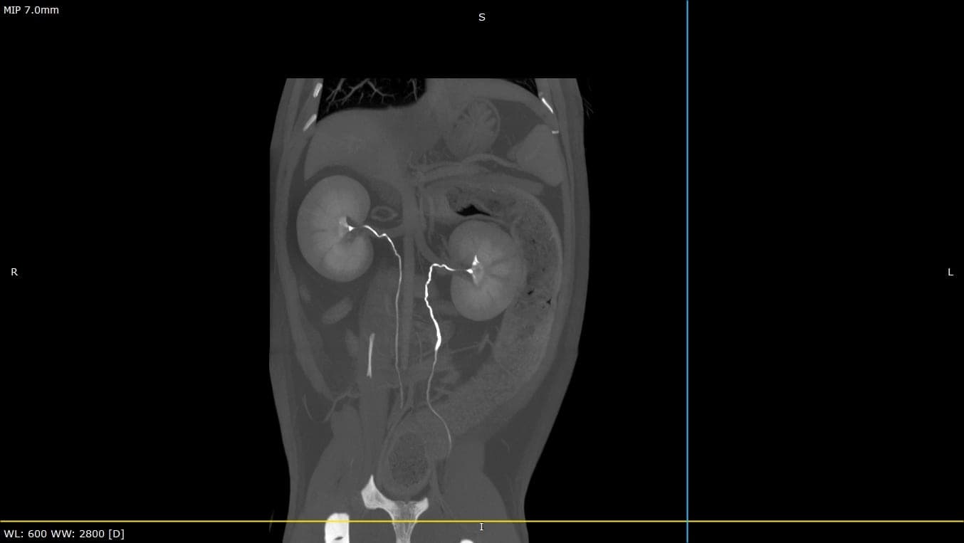 Coronal abdominal slice showing both kidneys