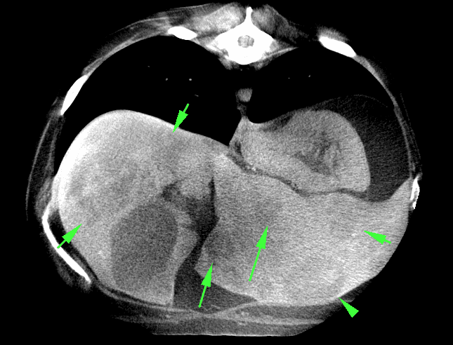 Axial chest slice with findings marked
